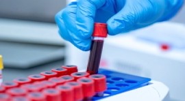 Pertinence médicale - Le SDBIO salue le rapport d’évaluation  de la HAS qui recommande de ne plus prescrire la vitesse de sédimentation